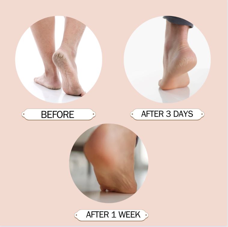 Foot Balm & Moisturizing Socks